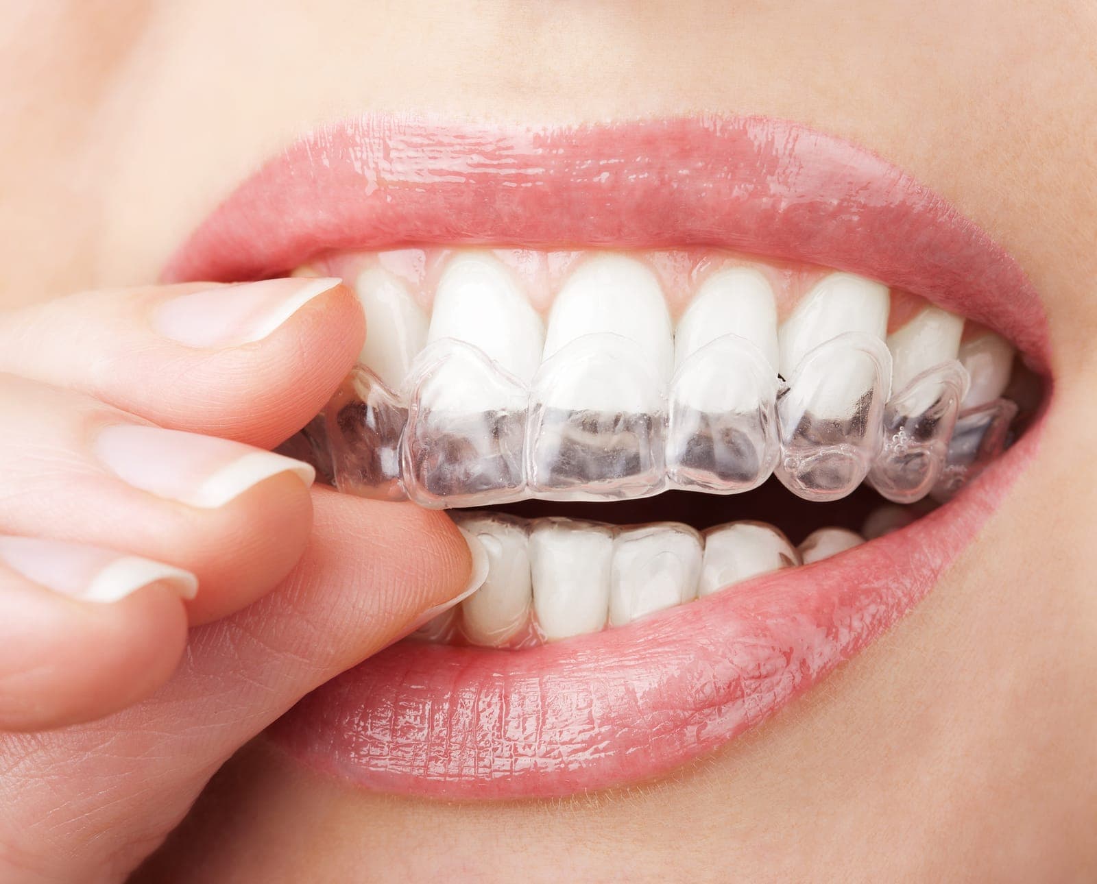 Patient holding a clear removable brace aligner
