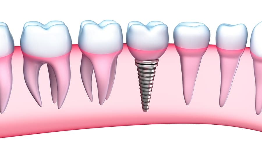 Illustration of a dental implant set into the jaw between natural teeth