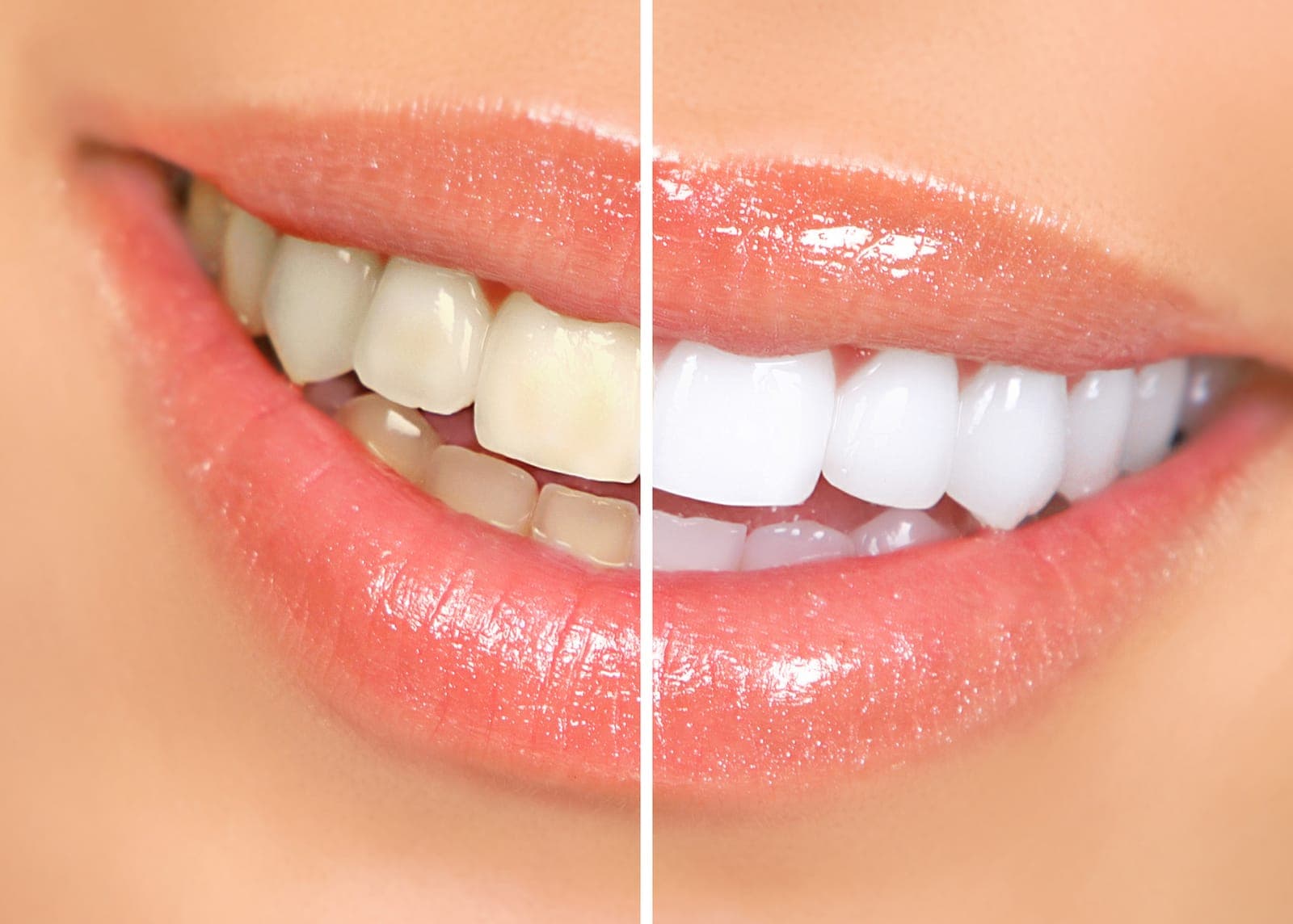 Close-up of a smile comparing tooth shades